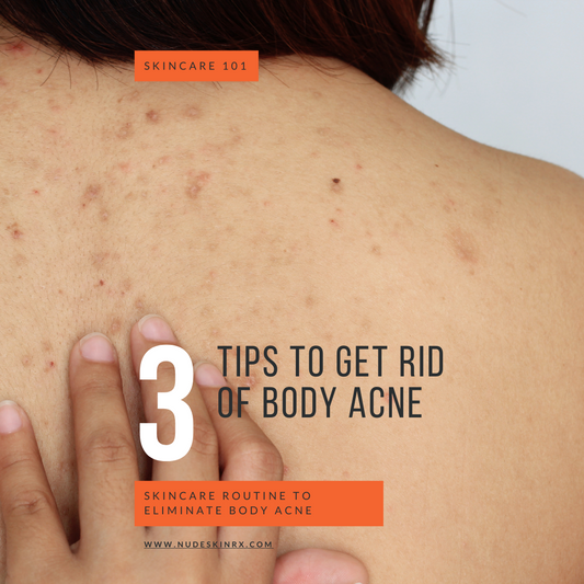 3 Ways To Get Rid Of Body Acne